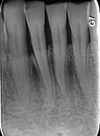 Radiografia Endorale